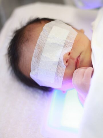 Newborn being treated for jaundice.